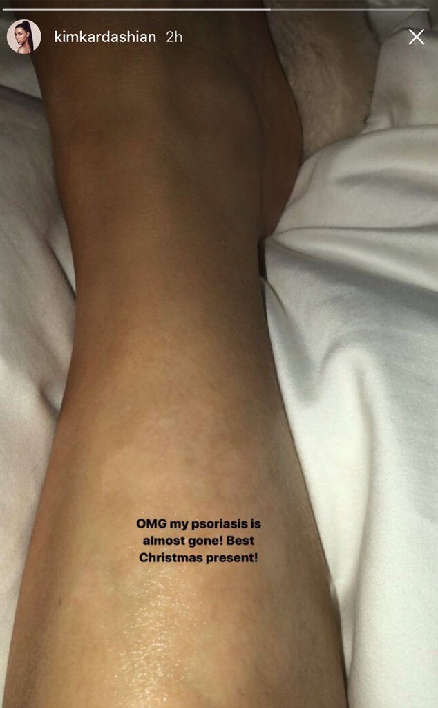 Kim Kardashian Reveals Reason Behind Huge Indent On Her Butt Al Bawaba