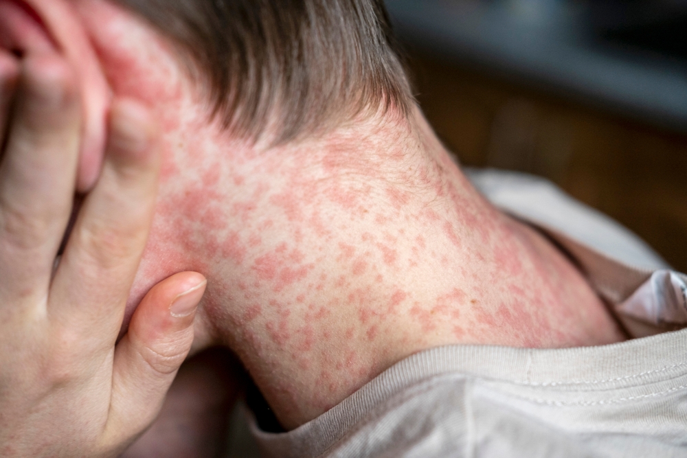 Measles outbreak kills another child in Texas
