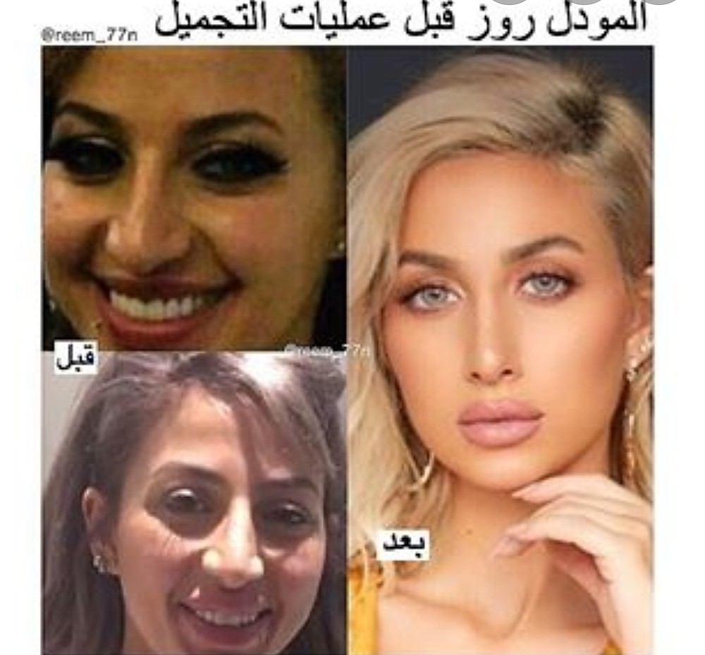 Model Roz's Old Photos Before Plastic Surgeries Shocks