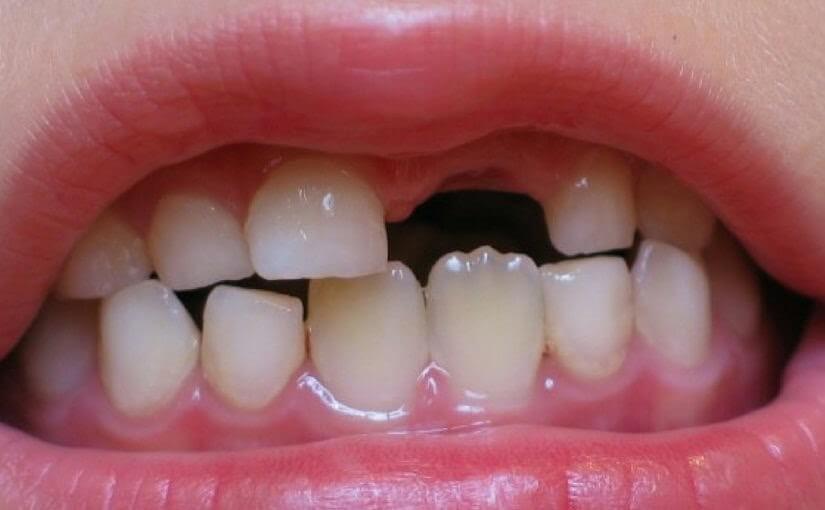 تفسير حلم سقوط سن واحد فقط للعزباء