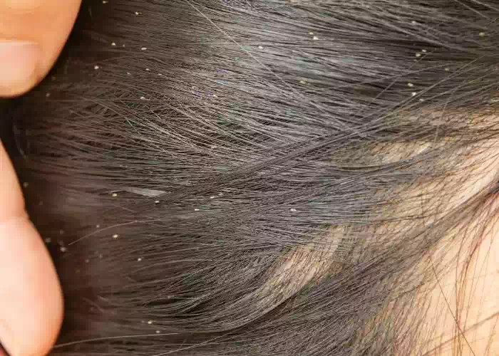 تفسير رؤية تساقط القمل من الشعر في المنام للمتزوجة لمختلف العلماء