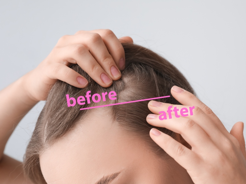 طبيب البوابة: ما علاقة الزنك بصحة الشعر ؟