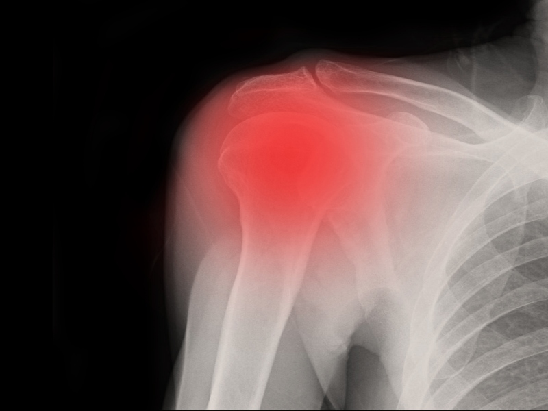 طبيب البوابة: أسباب الكتف المتجمد وطرق علاجه