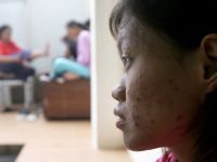 WHO declares Mpox a global health emergency