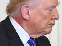 "بقعة حمراء" في رقبة ترامب