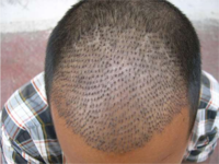hair implants