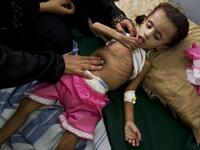 Yemen issues: Starving child in Yemen 