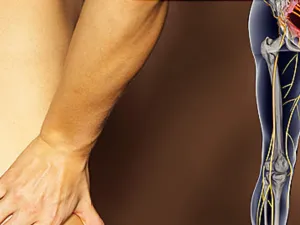 طبيب البوابة: أسباب واعراض عرق النسا