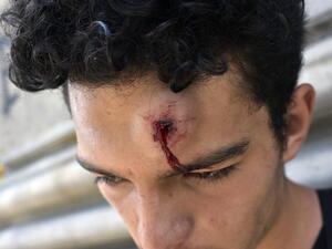 A demonstrator injured after receiving a pellet shot from riot police in Valparaiso, on the sixth straight day of protests which erupted over a now suspended hike in metro ticket prices, on October 23, 2019. A four-year-old child was killed during the latest round of protests against economic inequality in Chile, raising the death toll to 18 as unions launched a general strike on Wednesday. Raul Goycoolea / AFP
