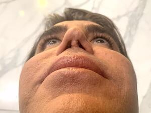 Sammy is meeting with the Botched doctors to see if they will be able to give him his old nose back. 'I would love to breathe better and for my nose to look better,' he says (dailymail)  