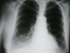 Xray of Chronic Obstructive Pulmonary Disease (Shutterstock)	