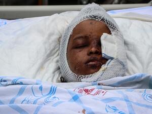 A wounded girl, from the December 28, 2019 car bombing in Mogadishu, is carried on a hospital bed to a Turkish Air Force aircraft for medical evacuation to Turkey at the Adan Adde international airport in Mogadishu on December 29, 2019. (AFP/ File Photo)