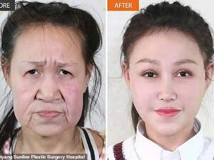 A handout picture released by China's Shenyang Sunline Plastic Surgery Hospital shows Xiao Feng's face before and after the surgery. The teenager met the public with her new looks today.(Shenyang Sunline Plastic Surgery Hospital)