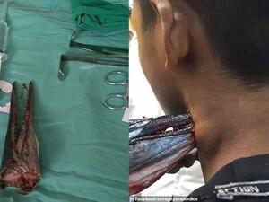 The needlefish (pictured) was removed in a delicate procedure two days after the attack. (Facebook)