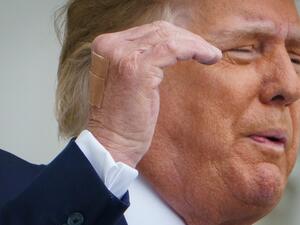 Bandages are seen on the back of his hand as US President Donald Trump speaks from the South Portico of the White House in Washington, DC during a rally on October 10, 2020. Trump spoke publicly for the first time since testing positive for Covid-19, as he prepares a rapid return to the campaign trail just three weeks before the election. MANDEL NGAN / AFP