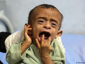 malnourishment and hunger is a devastating experience in Yemen (AFP File Folder)  Spare a thought for the Yemeni kids