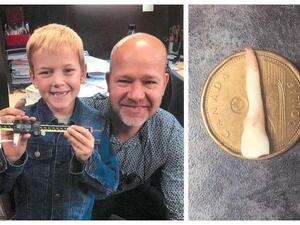 Luke Boulton won world record for longest tooth