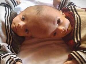 Yemeni conjoined twins Yousef and Yassin