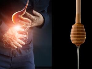 طبيب البوابة: العلاجات المنزلية للقرحة
