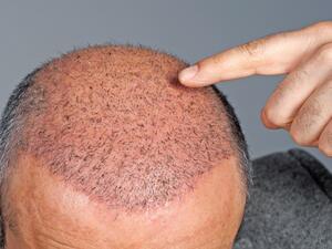 زراعة الشعر في الحلم