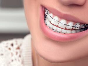 يجب عليكِ الإلتزام بمواعيد طبيب الأسنان لفحص التقويم والتأكد من عدم وجود أي مشكلة