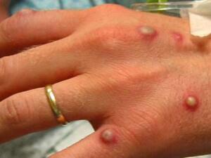 جدرى القرود