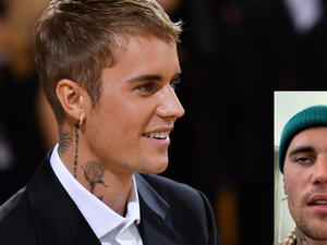 Justin Bieber has facial paralysis