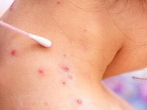  رصد حالة إصابة بمرض جدري القرود لشخص عائد من خارج المملكة