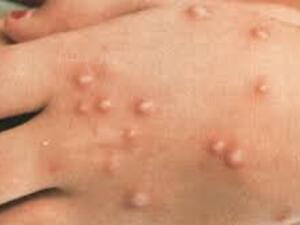  فايروس جدري القرود