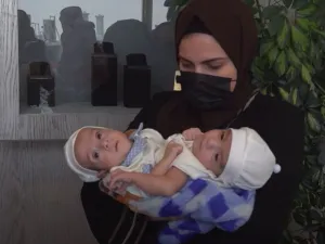 يشارك في عملية فصل التوامين وهما أبناء المواطن العراقي محمد عبدالله جاسم، 27 من الاستشاريين 