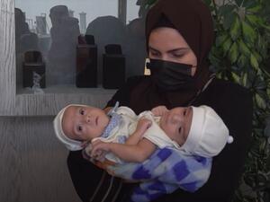 يشارك في عملية فصل التوامين وهما أبناء المواطن العراقي محمد عبدالله جاسم، 27 من الاستشاريين 