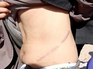 اثار عملية جراحية على شخص قام بالتخلي عن كليته