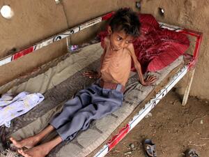 طفل يبلغ من العمر 10 سنوات يعاني من سوء التغذية الحاد بمحافظة حجة اليمنية