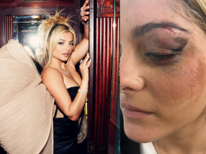 the man who hit Rexha with his phone purposely aimed for her face