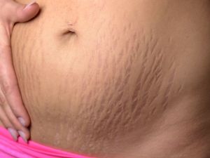 3 كريمات مختبرة لإزالة علامات التمدد المزعجة ونصائح حول كيفية تطبيقها