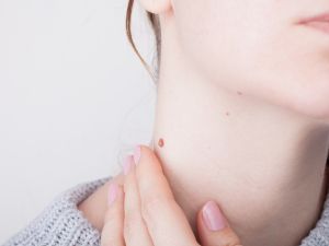 طبيب البوابة: طرق علاج التقرن الدهني (Seborrheic keratosis) 