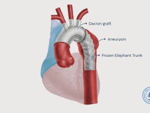  Breakthrough in Cardiac Surgery: AUBMC Performs the First Successful Frozen Elephant Trunk Surgery in Lebanon