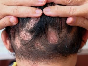 علاجات طبيعية ومنزلية للثعلبة والصلع في مقدمة الرأس علاجات طبيعية ومنزلية للثعلبة والصلع في مقدمة الرأس