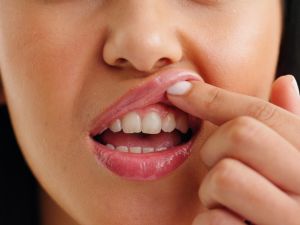 أسباب التهاب اللثة المستمر