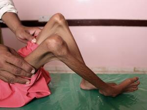 A Yemeni child suffering from malnutrition receives care at a treatment centre in a hospital in Yemen (AFP)