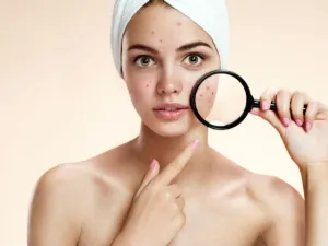 يلعب التوتر دورًا في التسبب بظهور حب الشباب (shutterstock.com)