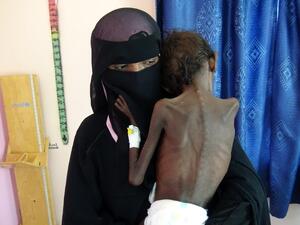 emeni mother Nadia Nahari holding her five-year-old son Abdelrahman Manhash, who is suffering from severe malnutrition and weighing 5 kilograms (AFP)