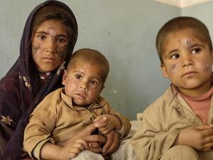 Three Afghan children infected with leishmaniasis sit on a hospital bed at the Maywan Hospital in Kabul. [AFP/Mandel Ngan]