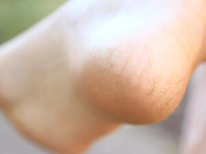 تعاني العديد من النساء من مشكلة تشقق القدمين خاصة في الشناء (shutterstock.com)