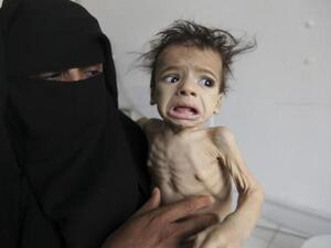 اليمن يعاني من أزمة غذائية اليمن يعاني من أزمة غذائية