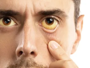 يقلل التهاب الكبد من قدرته على التخلص من البيليروبين مما يؤدي لتراكمه

