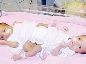 التوأمان السعوديتان رنا وريم     التوأمان السعوديتان رنا وريم