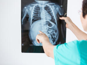 سرطان العظام مرض خبيث يعمل على تدمير خلايا العظم السّليمة
