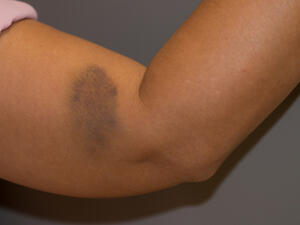 من أسباب ظهور الكدمات تناول أنواع الأدوية التي تسبّب تميّعاً في الدّم

