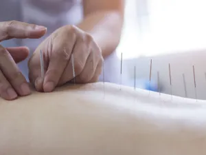 العلاج بالإبر،المستمد من الطب الصيني القديم قد يكون بديلاً لعلاج أعراض الدورة (Shutterstock)
